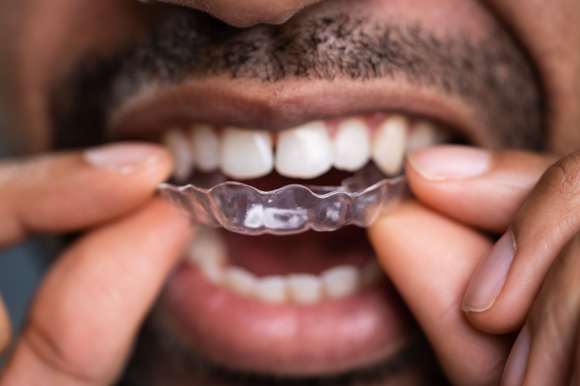 Mountain West Dental Specialists Invisalign