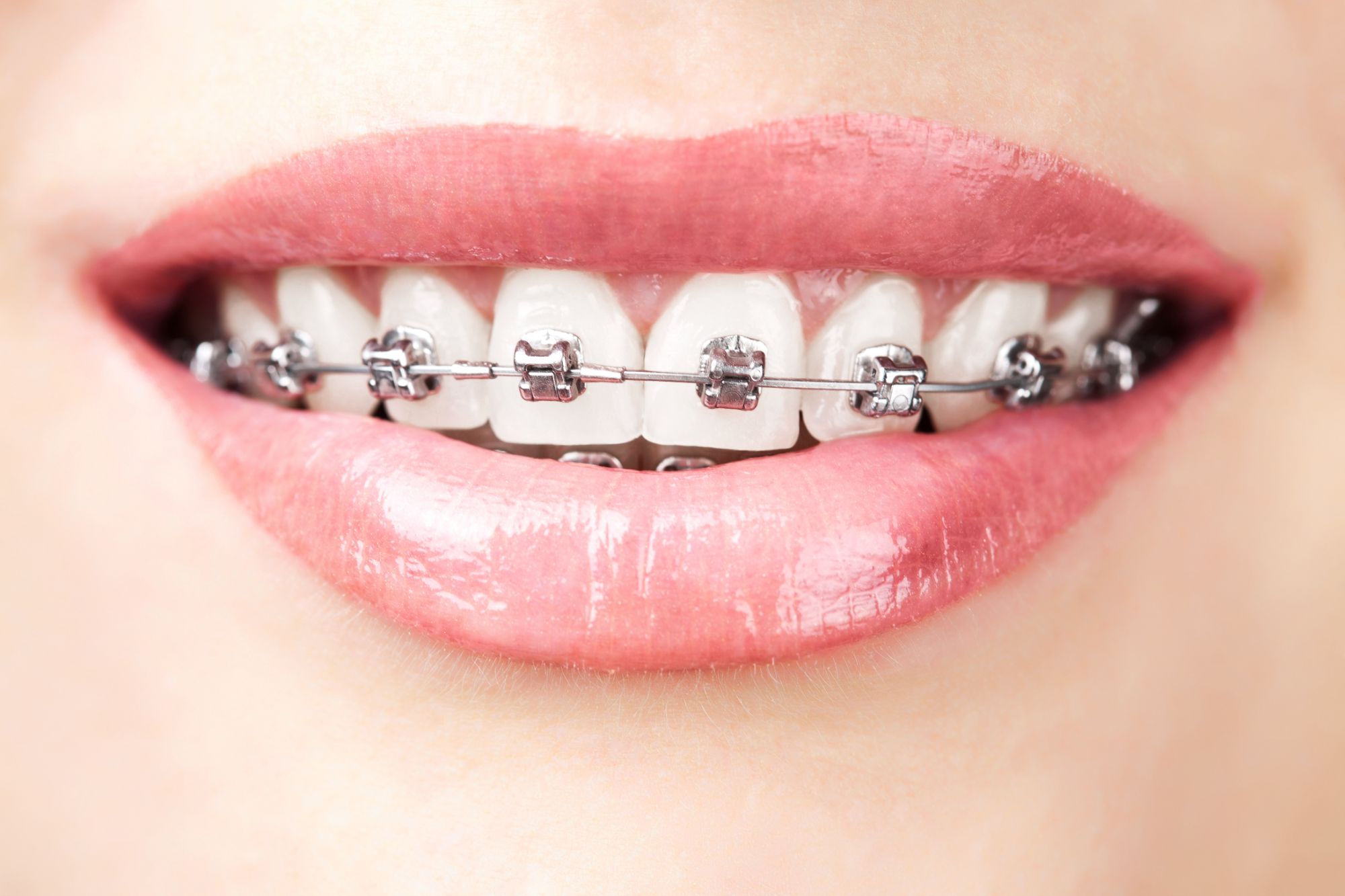 Mountain West Dental Specialists Metal Braces