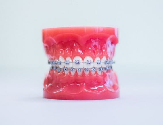 Metal braces at las vegas orthodontists